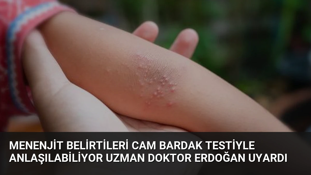 Menenjit Belirtileri Cam Bardak Testiyle Anlaşılabiliyor Uzman Doktor Erdoğan Uyardı