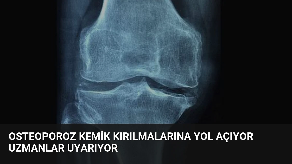 Osteoporoz Kemik Kırılmalarına Yol Açıyor Uzmanlar Uyarıyor