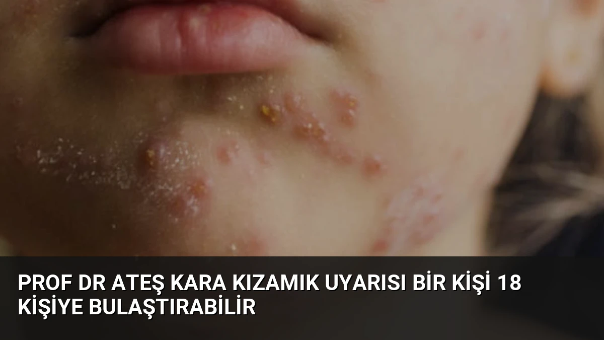 Prof Dr Ateş Kara Kızamık Uyarısı Bir Kişi 18 Kişiye Bulaştırabilir