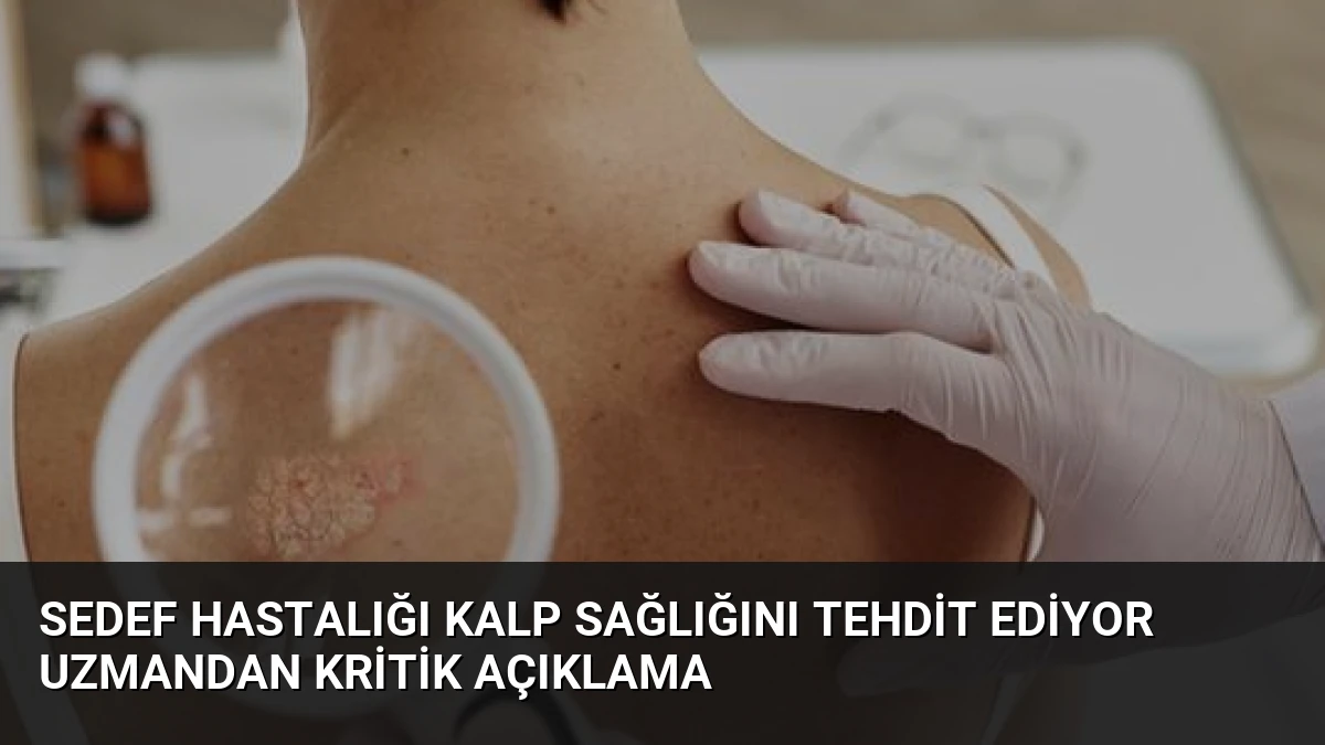 Sedef Hastalığı Kalp Sağlığını Tehdit Ediyor Uzmandan Kritik Açıklama